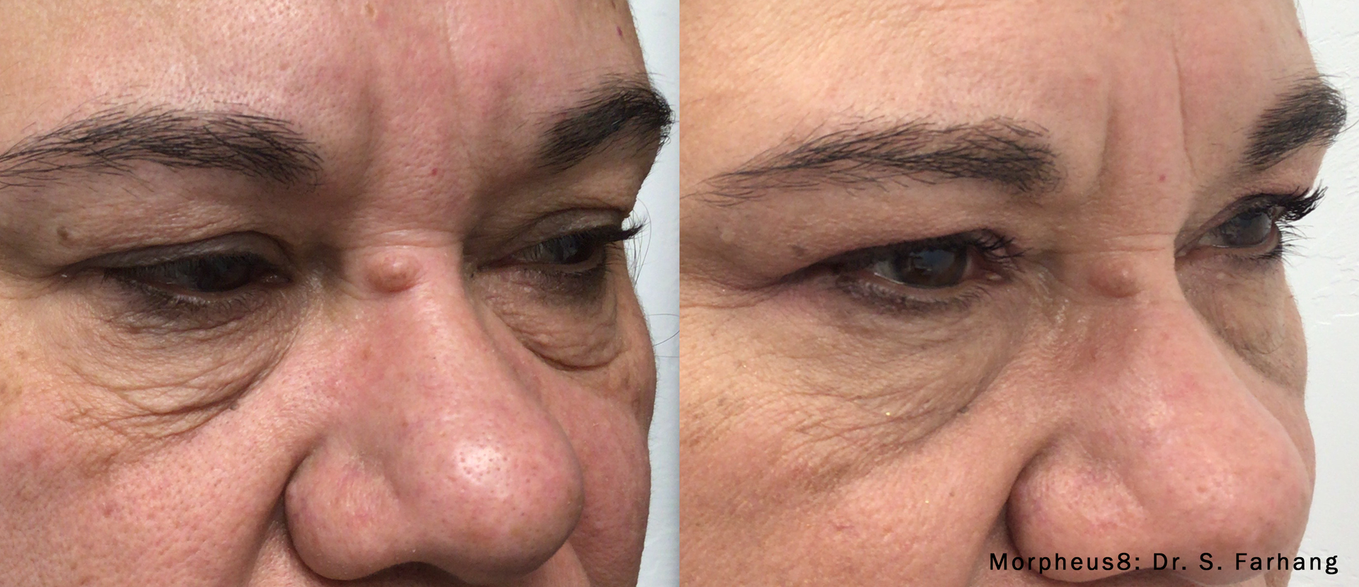 A before and after photo of a woman 's eye surgery.